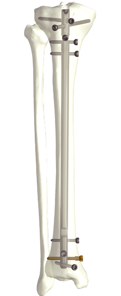 Clavo intramedular de Tibia (Suprarrotuliano + Infrarrotuliano)