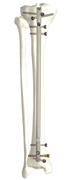 Clavo intramedular de Tibia (Suprarrotuliano + Infrarrotuliano)