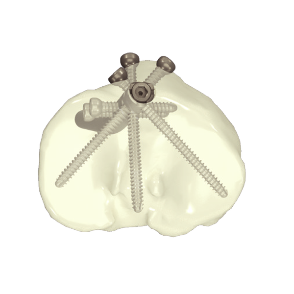 Clavo intramedular de Tibia (Suprarrotuliano + Infrarrotuliano) - Imagen 2