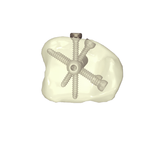 Clavo intramedular de Tibia (Suprarrotuliano + Infrarrotuliano) - Imagen 3