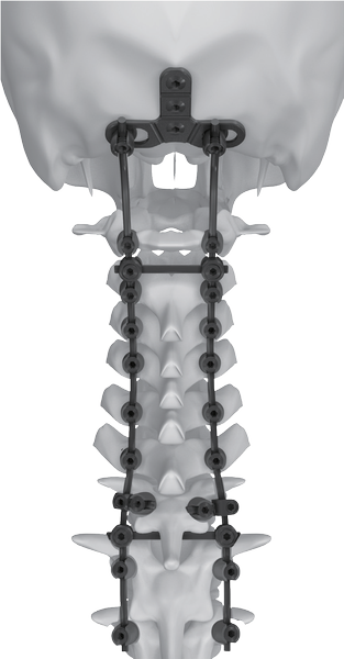 Sistema de Fijación Occipito-Cervical CERES 3.5 - Imagen 2