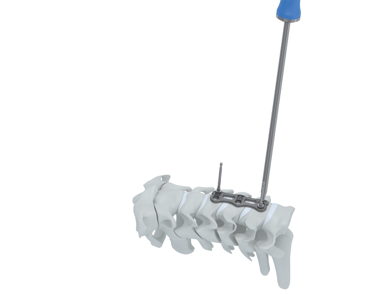 Placa Cervical Anterior CAMIC - Imagen 3