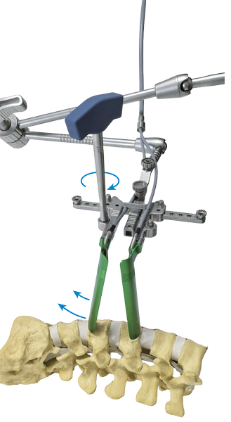 Retractor Lumbar Lateral - Imagen 3