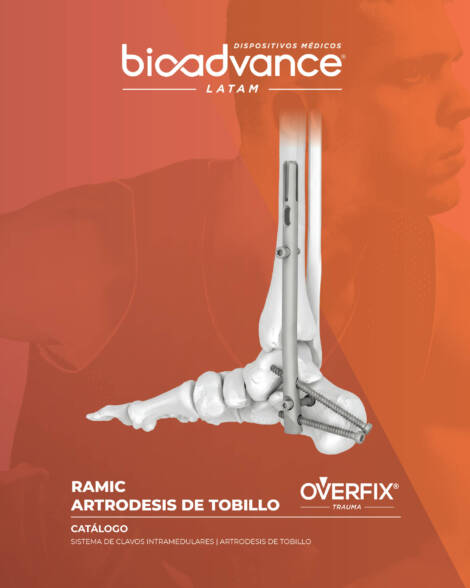 Artrodesis de Tobillo RAMIC