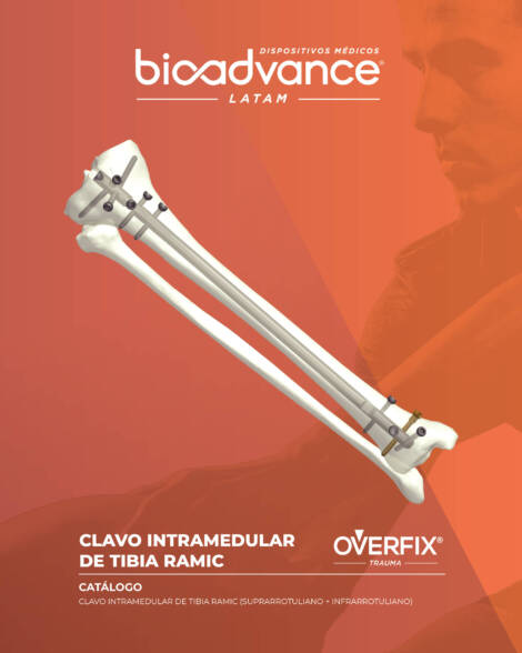 Clavo intramedular de Tibia (Suprarrotuliano + Infrarrotuliano)