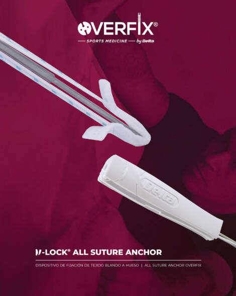 V LOCK