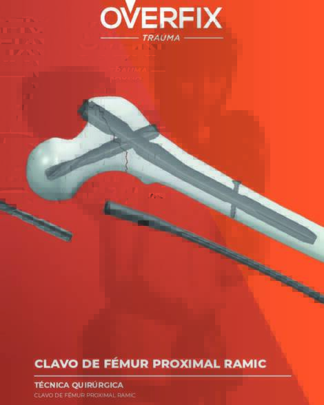 Clavo de Fémur Proximal RAMIC