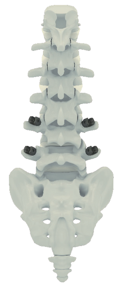 Cervical Cage Coales-AC (2T)
