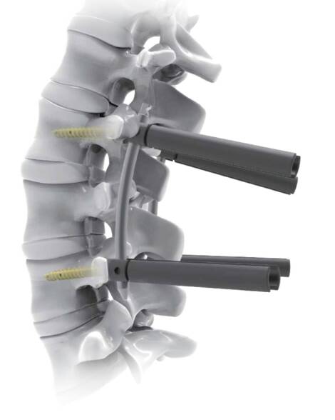 Sistema de Fijación Posterior de Columna OVERFIX SPINE PLUS