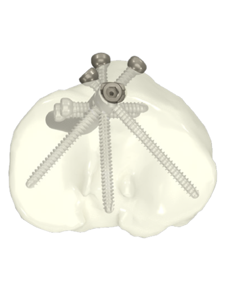 Clavo intramedular de Tibia RAMIC